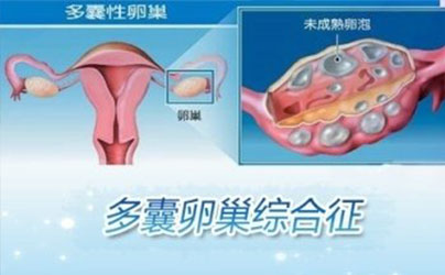 多囊卵巢