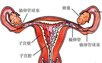 输卵管不孕